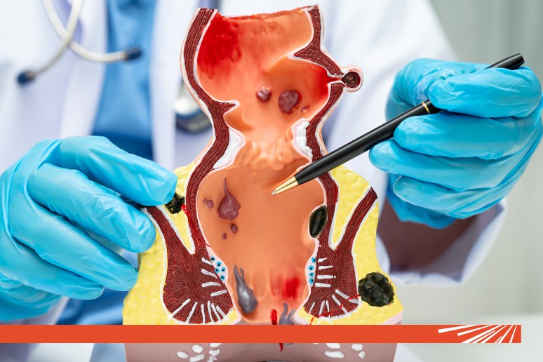 Fistula perianală: ce este și cum poate fi tratată?