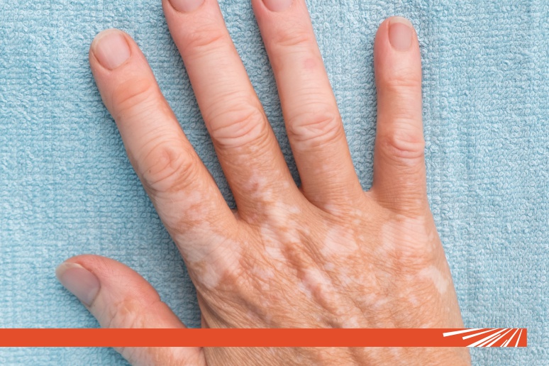Pete albe pe piele – ce pot ascunde și când este recomandat consultul dermatologic?
