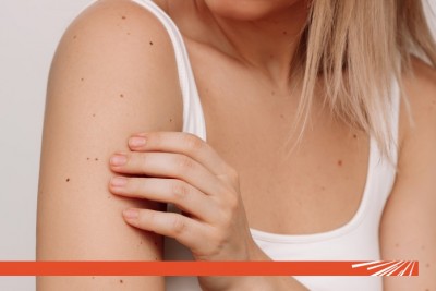 Ghid de autoevaluare: Detectarea timpurie a melanomului – De ce regula ABCDE și controlul anual sunt importante?